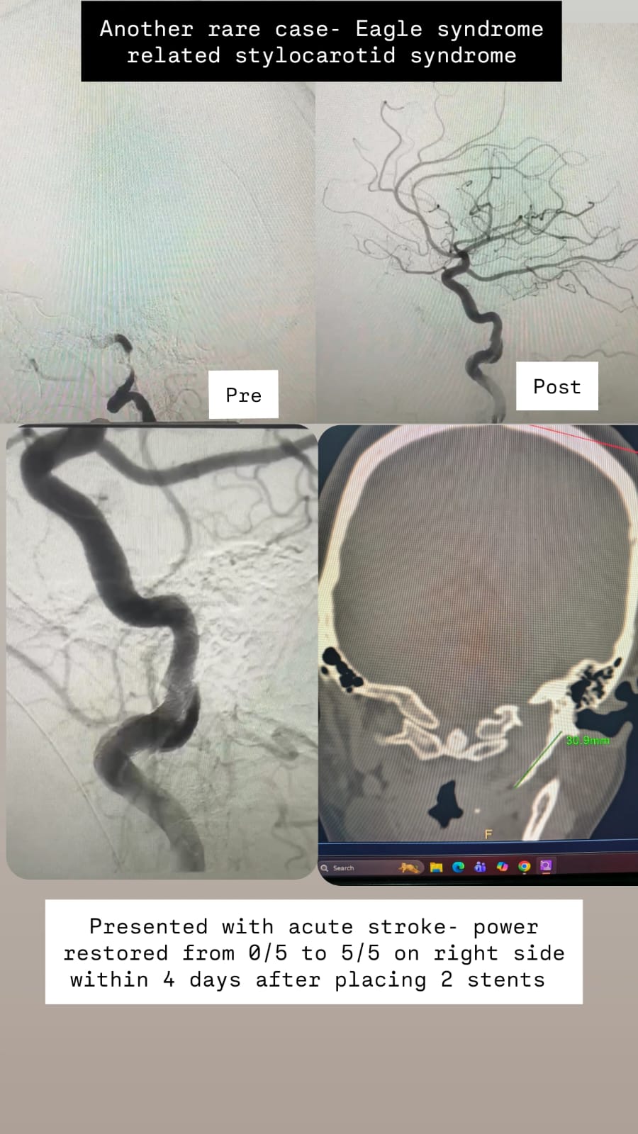 Stroke Intervention