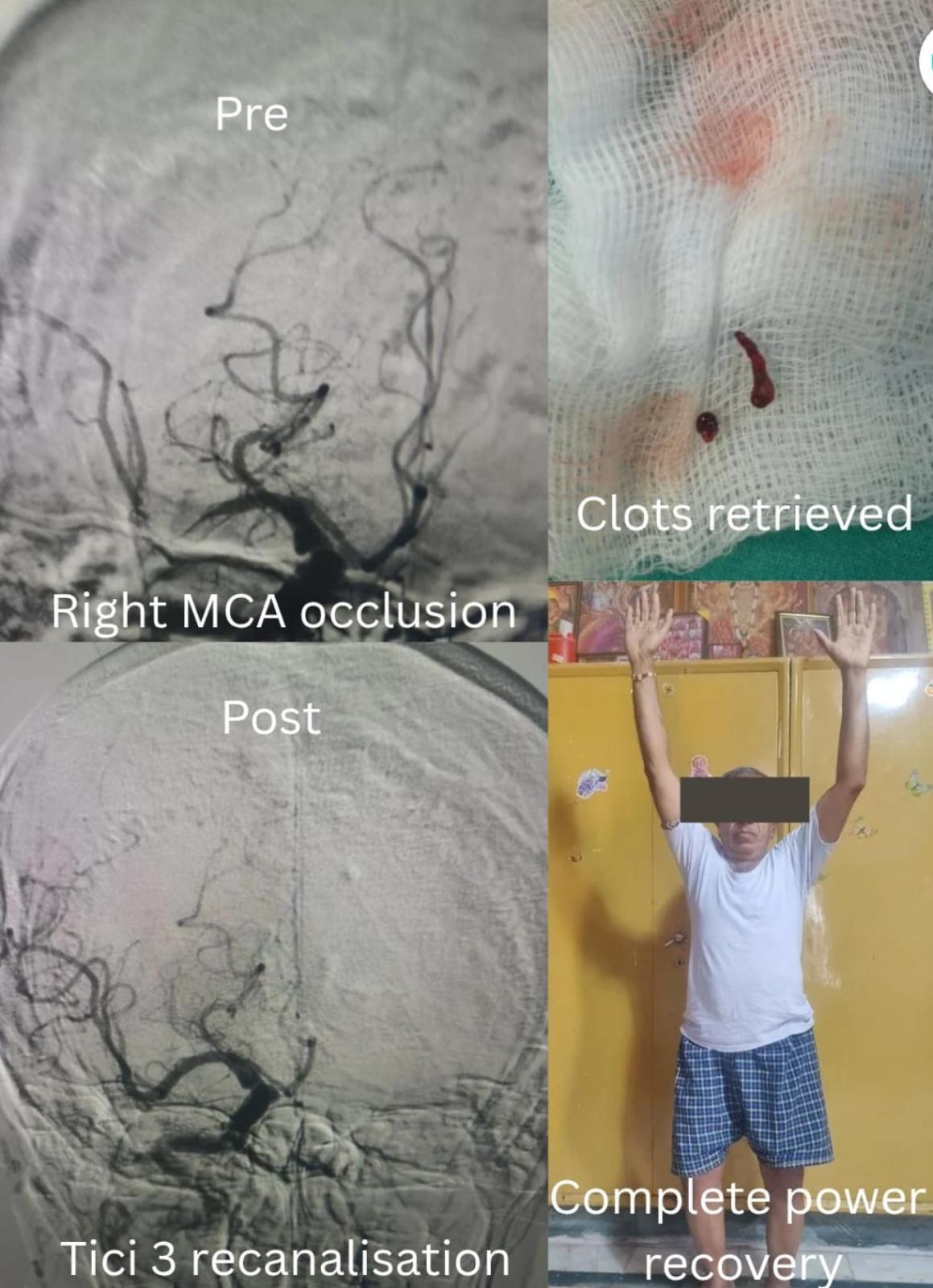 Mechanical Thrombectomy via Radial Artery